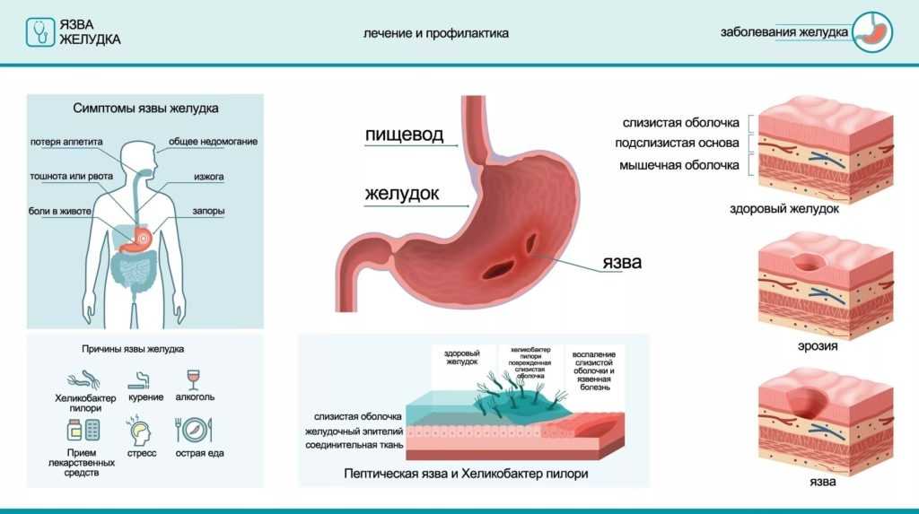 Як лікувати підвищену кислотність шлунка?